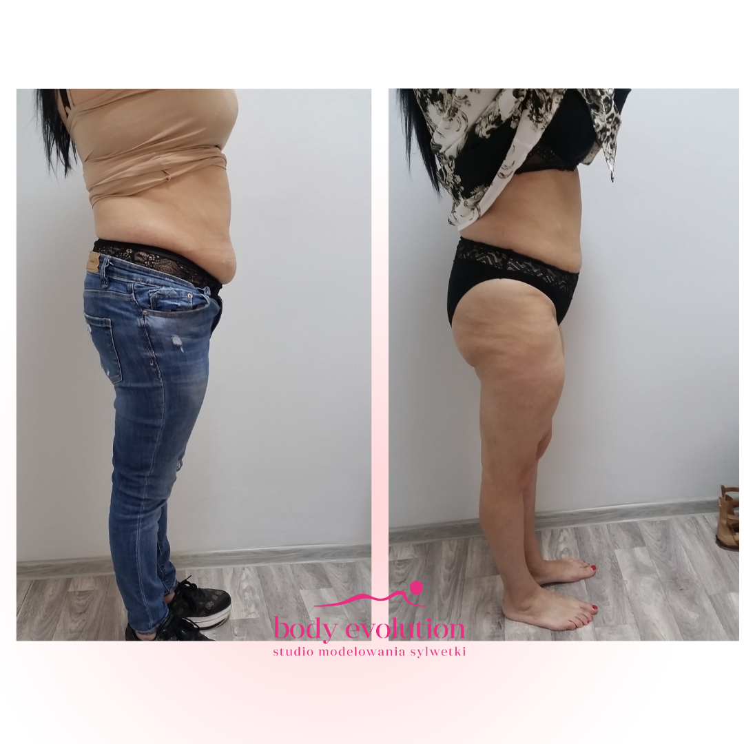 Efekty kriolipolizy – zdjęcie 2