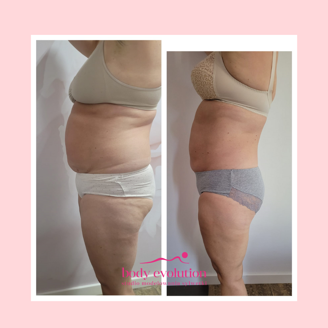Endermologia efekty – zdjęcie 2