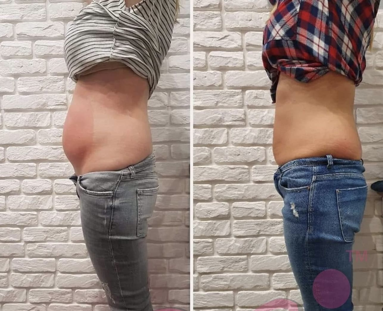 Efekty kriolipolizy – zdjęcie 3
