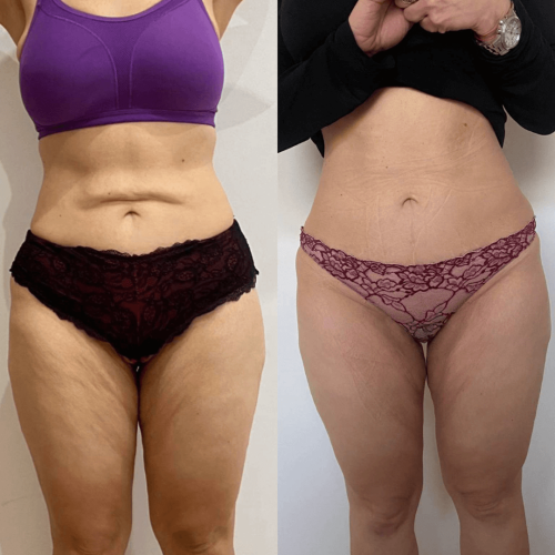 Endermologia efekty Endermologia efekty