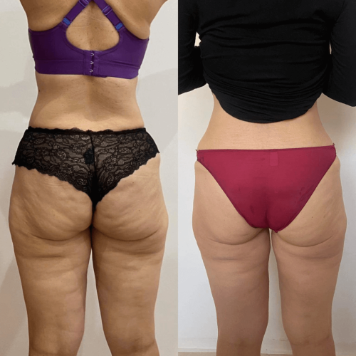 Endermologia efkety Endermologia LPG Legionowo
